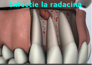 Root infection