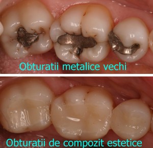 Dental fillings