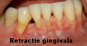 Gingival recession