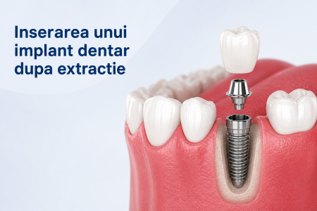 Implantul Dentar Dupa Extractie Implantul Dentar Dupa Extractie
