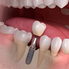 Implant dentar