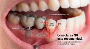 Lucrare implant - dinte