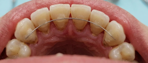 Close-up of the upper teeth with a fixed retainer wire on the inside spanning the front teeth (lingual retainer).
