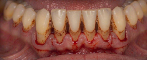 Close-up of lower front teeth showing significant gum recession and brown calculus along the gumline, with inflamed red gums and exposed roots.