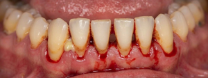 Lower front teeth with heavy gum bleeding and exposed tooth roots, indicating periodontal disease and tissue recession around multiple teeth.